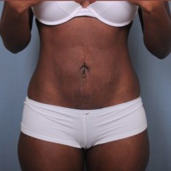 Liposuction Before & After Patient #1870