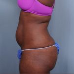 Liposuction Before & After Patient #1870