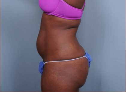 Liposuction Before & After Patient #1870