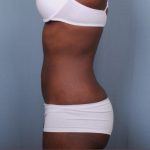 Liposuction Before & After Patient #1870