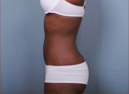 Liposuction Before & After Patient #1870