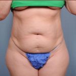 Liposuction Before & After Patient #1869