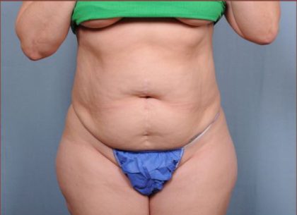 Liposuction Before & After Patient #1869