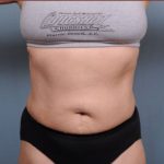 Liposuction Before & After Patient #1869