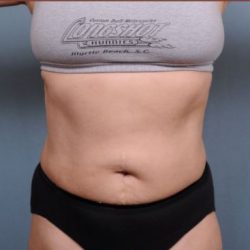 Liposuction Before & After Patient #1869