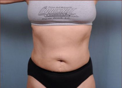 Liposuction Before & After Patient #1869