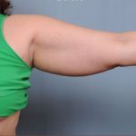 Liposuction Before & After Patient #1869