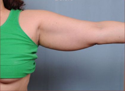 Liposuction Before & After Patient #1869