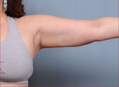Liposuction Before & After Patient #1869