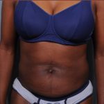 Liposuction Before & After Patient #1868
