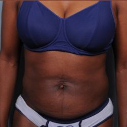 Liposuction Before & After Patient #1868