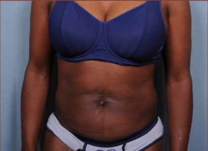 Liposuction Before & After Patient #1868