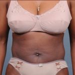 Liposuction Before & After Patient #1868