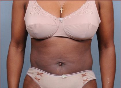 Liposuction Before & After Patient #1868