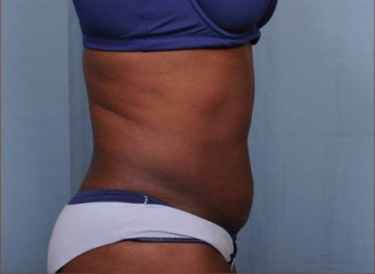 Liposuction Before & After Patient #1868