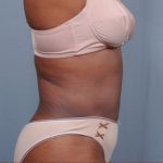 Liposuction Before & After Patient #1868