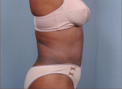 Liposuction Before & After Patient #1868