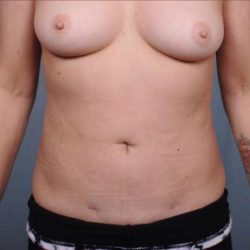 Liposuction Before & After Patient #1867