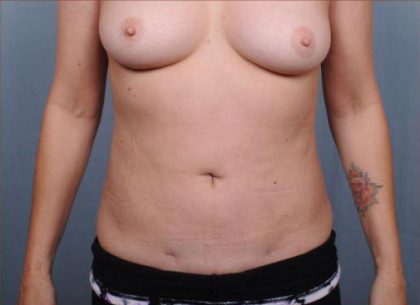Liposuction Before & After Patient #1867