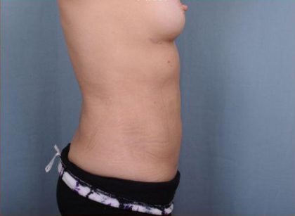 Liposuction Before & After Patient #1867