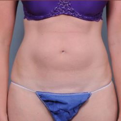 Liposuction Before & After Patient #1866