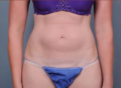 Liposuction Before & After Patient #1866
