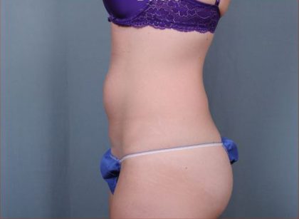 Liposuction Before & After Patient #1866