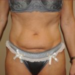 Liposuction Before & After Patient #1865