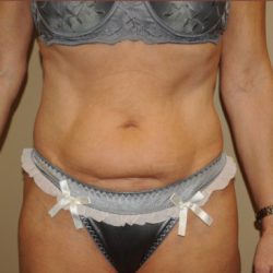 Liposuction Before & After Patient #1865