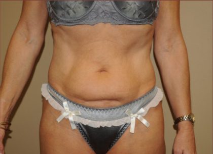 Liposuction Before & After Patient #1865