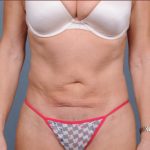 Liposuction Before & After Patient #1865