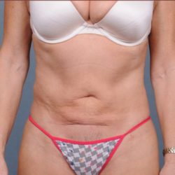 Liposuction Before & After Patient #1865