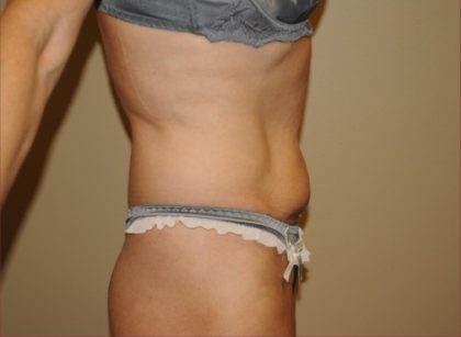 Liposuction Before & After Patient #1865