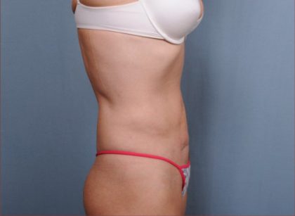 Liposuction Before & After Patient #1865