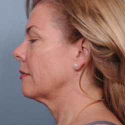 Liposuction Before & After Patient #1864
