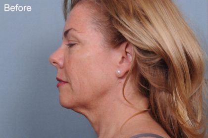 Liposuction Before & After Patient #1864