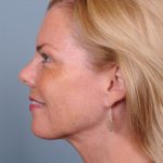 Liposuction Before & After Patient #1864