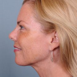 Liposuction Before & After Patient #1864