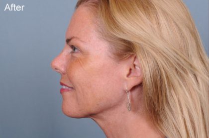 Liposuction Before & After Patient #1864