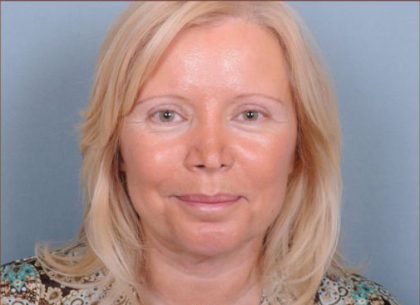 Liposuction Before & After Patient #1863