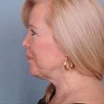Liposuction Before & After Patient #1863