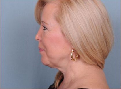 Liposuction Before & After Patient #1863