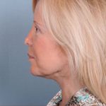 Liposuction Before & After Patient #1863