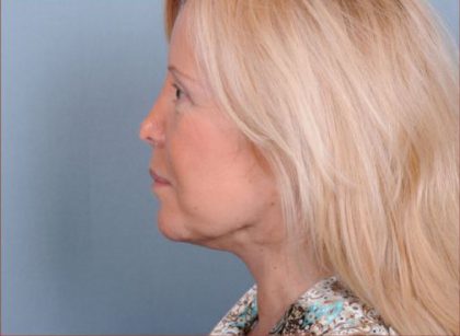Liposuction Before & After Patient #1863