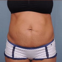 Abdominoplasty Before & After Patient #1881