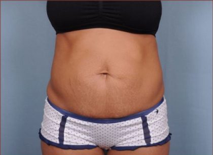 Abdominoplasty Before & After Patient #1881