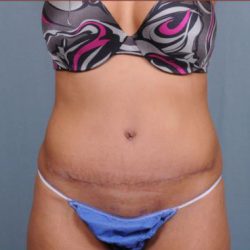 Abdominoplasty Before & After Patient #1881
