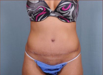 Abdominoplasty Before & After Patient #1881