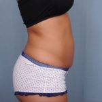 Abdominoplasty Before & After Patient #1881