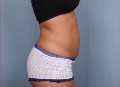 Abdominoplasty Before & After Patient #1881